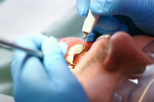 Best Emergency Root Canal Treatment in Pinecrest, FL